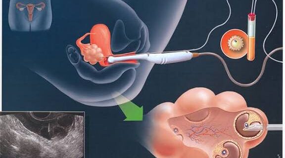 Sun'iy Urug'lantirish