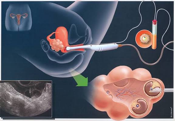 Sun'iy Urug'lantirish
